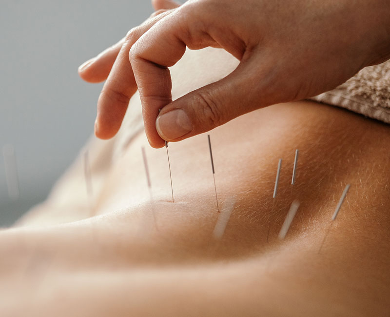 4767-acupuncture